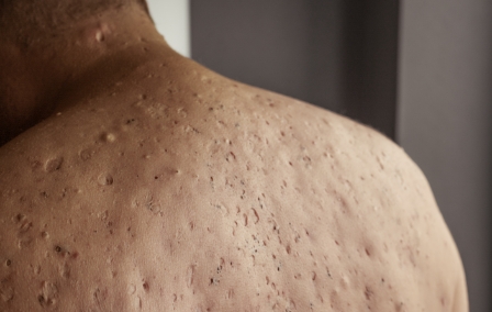 Hidradenitis Suppurativa Treatments