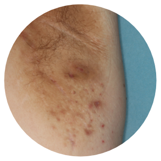 Hidradenitis Suppurativa Stages Signs